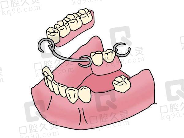 全口假牙怎样固定不掉