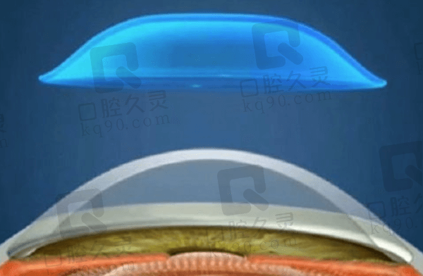 十大品牌梦戴维与阿尔法的角膜塑形镜价格对比