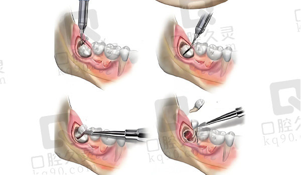智齿拔出步骤