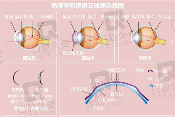 深圳悦瞳眼科医院阿尔法角膜塑形镜怎么样