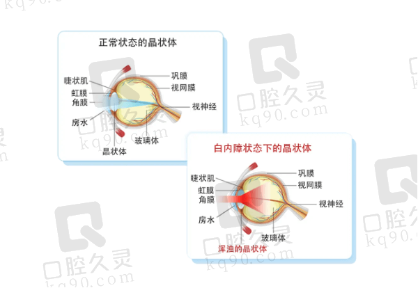 白内障飞秒激光好还是人工晶体好？从白内障飞秒激光手术与人工晶体手术的适应症分析：