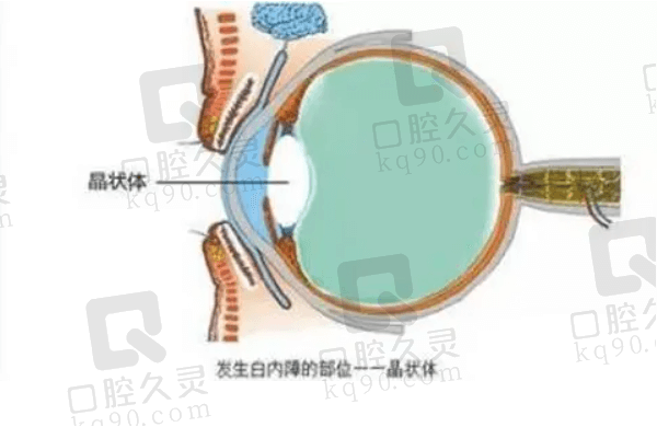 白内障飞秒激光好还是人工晶体好？从白内障飞秒激光手术与人工晶体手术的清晰度对比