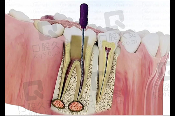 显微根管治疗的优势