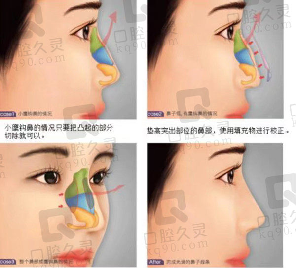 进行肋软骨隆鼻整形注意事项