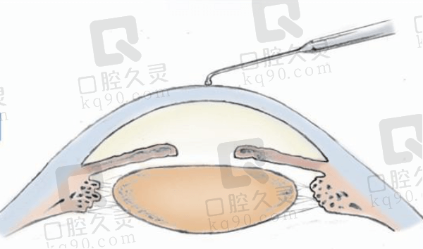 金华眼科医院价格一览表2024：近视手术价格9000元起！