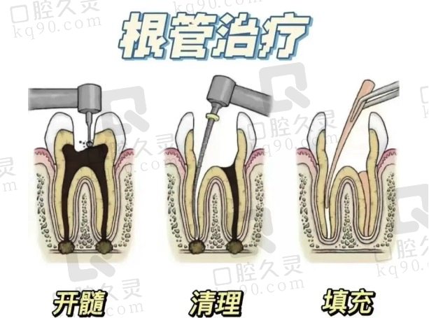 嘉兴平湖麦芽口腔做根管治疗多少钱？