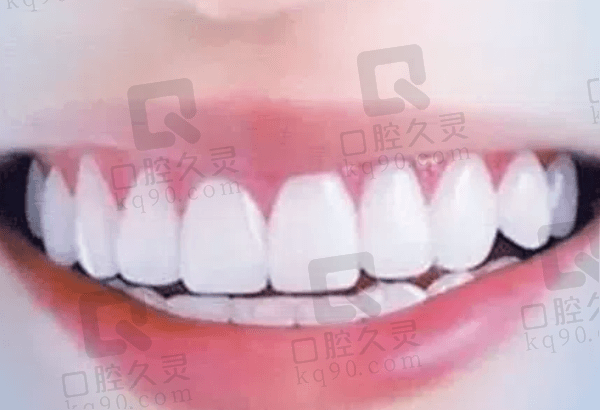 牙齿贴面使用时间的影响因素