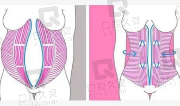 济南韩氏整形外科医院腹壁成形术怎么样