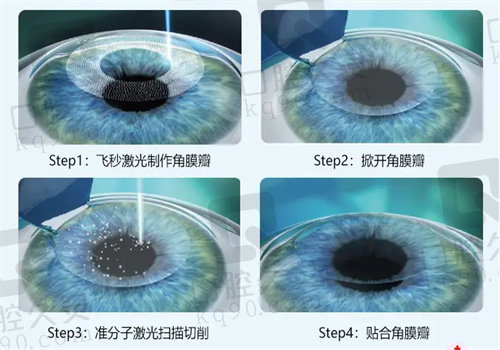 武汉汉阳艾格眼科医院全飞秒近视手术价格表