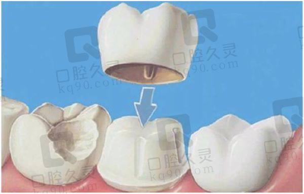 广州中家医家庭口腔德国进口西诺德全瓷冠怎么样