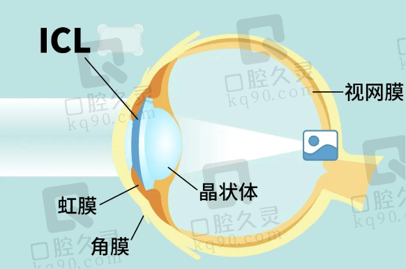 惠州明康眼科医院高稳生医生擅长晶体植入术