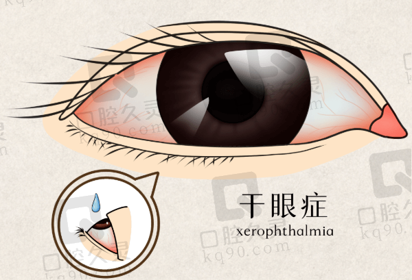 干眼症的护理方法