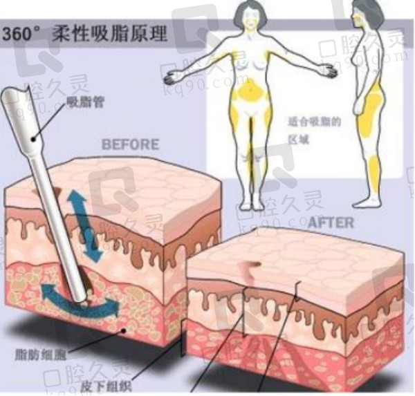 济南郭广科做吸脂有凹凸不平吗