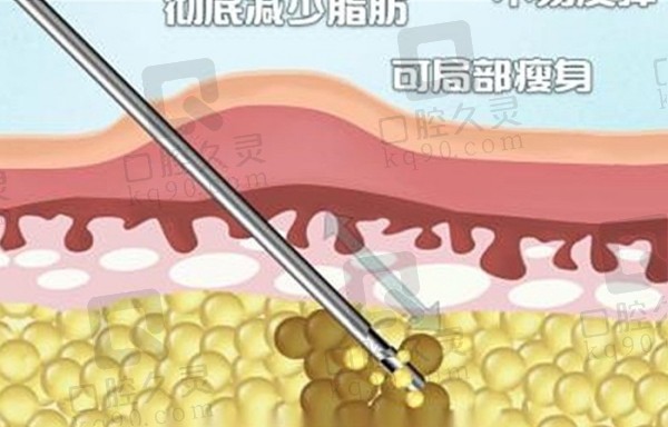 济南韩氏整形外科医院郭广科医生做吸脂手术十分的平整