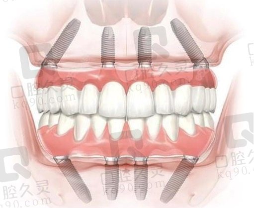 深圳美莱口腔做全口种植牙多少钱？