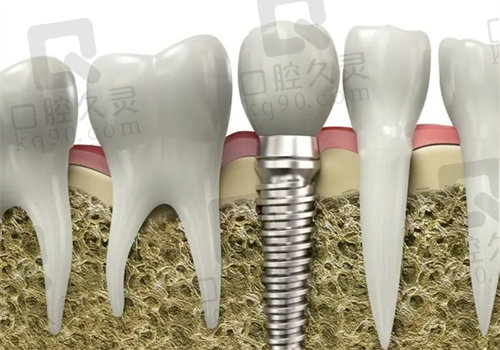 太原鼎植口腔医院种植牙多少钱