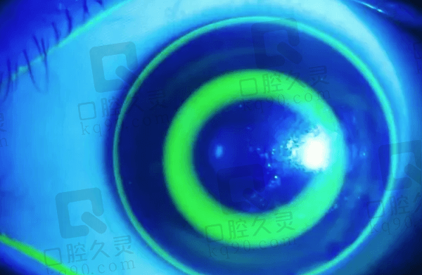 上海爱尔眼科医院配RGP角膜塑形镜怎么样？