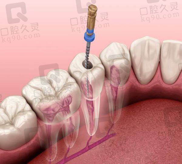 广州广大口腔根管治疗推荐医生