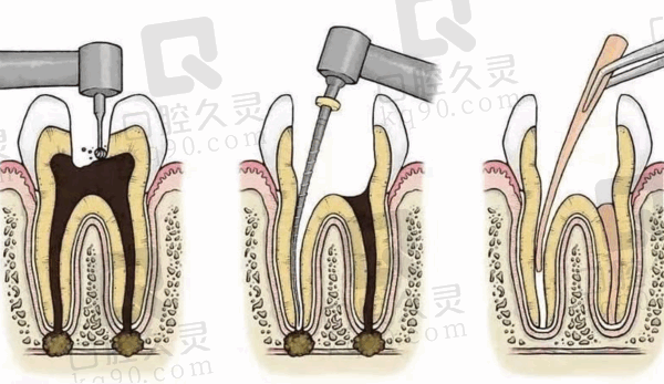 广州广大口腔根管治疗怎么样