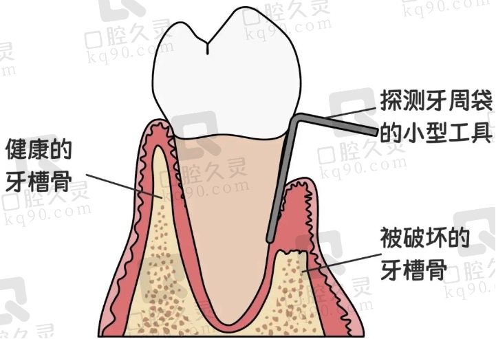 深圳美莱口腔治疗牙周炎多少钱？