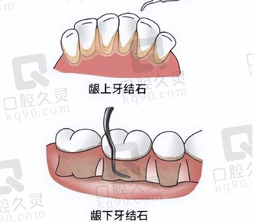 深圳美莱口腔龈下刮治的特色