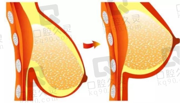 南京艺星假体隆胸怎么样