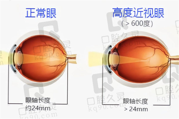 高度近视无散光适合选择晶体植入手术