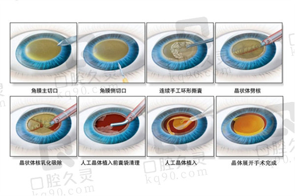 ICL晶体植入手术手术全过程分享