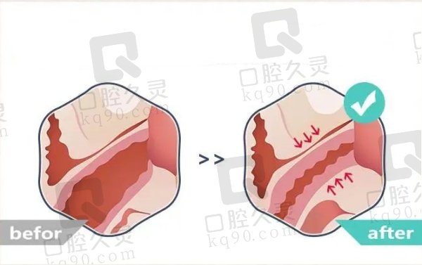 3D生物束带紧缩术真的有效吗