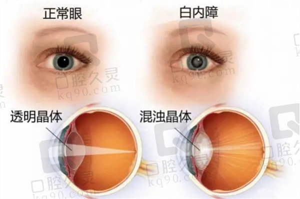 白内障超声乳化摘除手术+人工晶体植入术属于几级手术