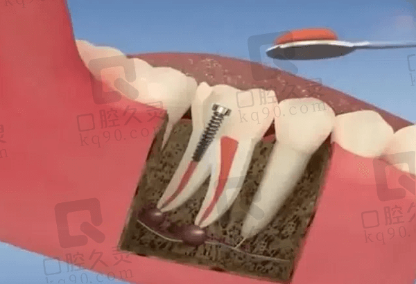 前磨牙根管治疗后必须做牙冠吗