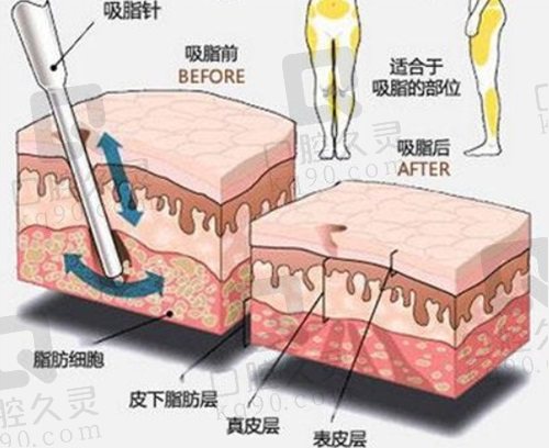 北京嘉禾医疗美容医院吸脂整形