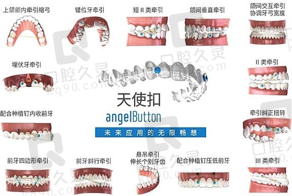 时代天使隐形矫正的优势