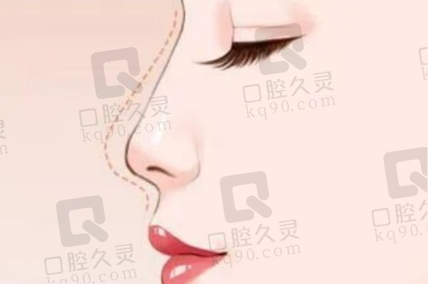 佛山曙光金子王棟做鼻子手術(shù)實(shí)例參考