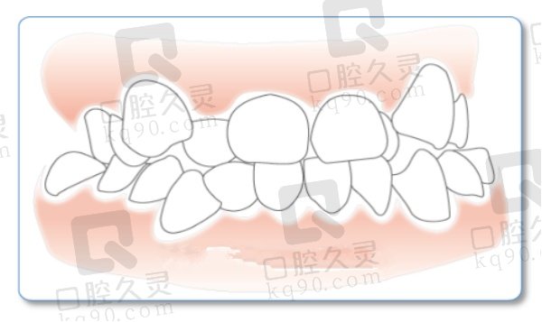 什么类型的牙齿需要做矫正