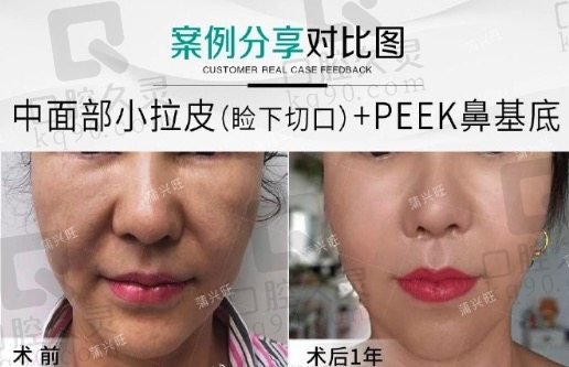 睑下切口中下面部小拉皮+peek鼻基底填充术后回复过程