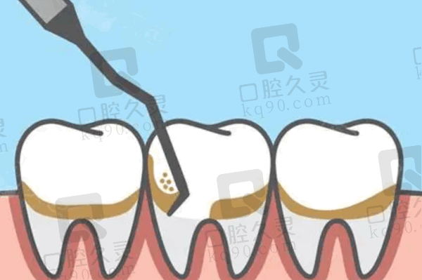 青岛优诺口腔全口龈下刮治多少钱