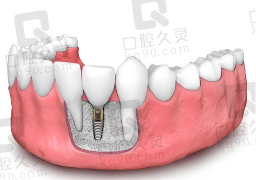 西安瑞秦口腔韩国进口种植牙多少钱