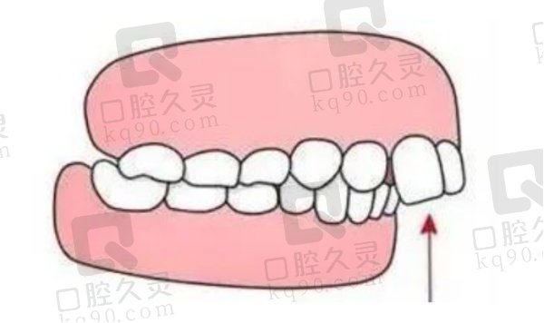 金属托槽矫正的注意事项