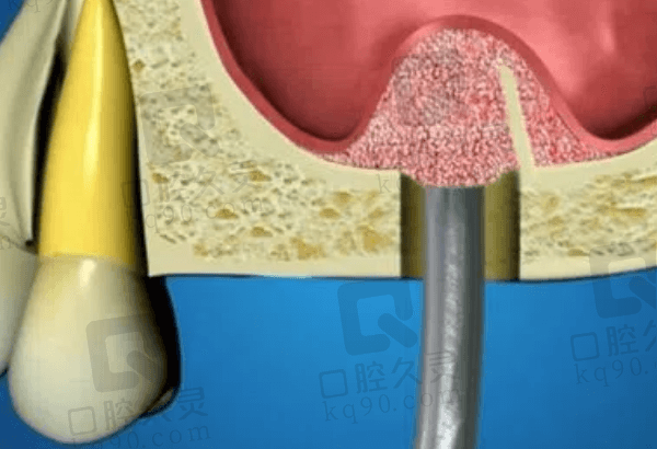 上颌窦提升植骨手术