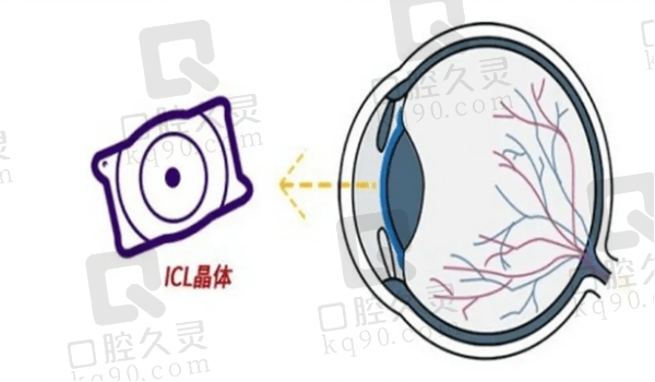 沈阳何氏眼科ICL晶体植入术的价格为27000元起