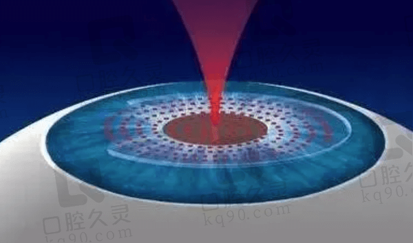 沧州爱尔眼科医院近视手术要求是什么？