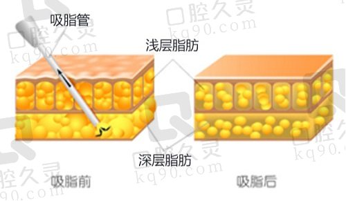 找冯斌吸脂花20万亲身经历