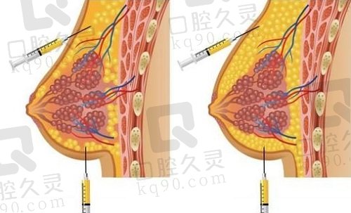 冯斌医生脂肪填充技术优点