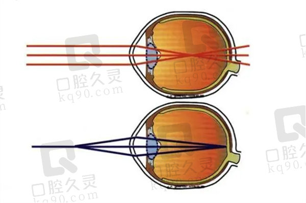 一只眼睛近视可以做近视手术吗