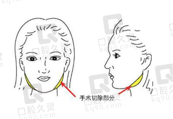 下颌骨整形手术成功机率高吗