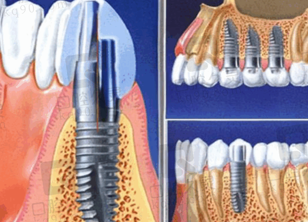 广州广大口腔医院种植牙多少钱