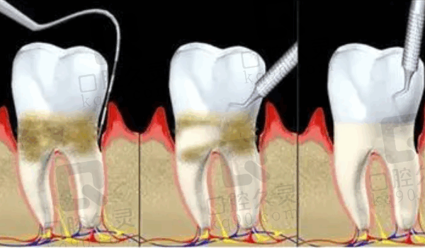 青岛牙博士口腔医院牙周治疗怎么样