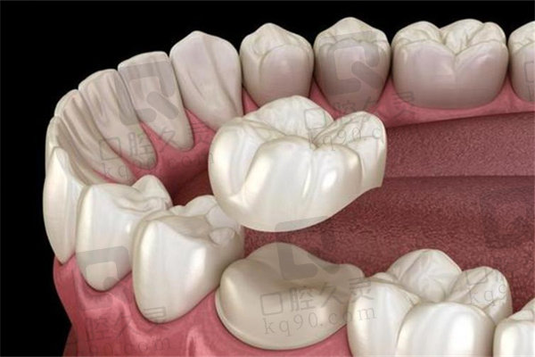 做牙冠一般建议选什么样的材料？
