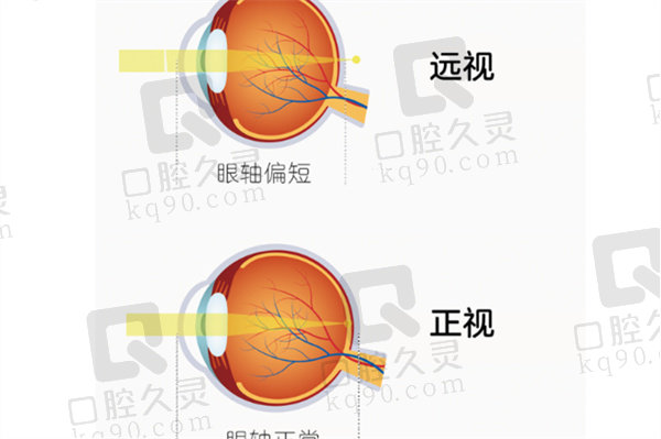 远视眼是怎么回事